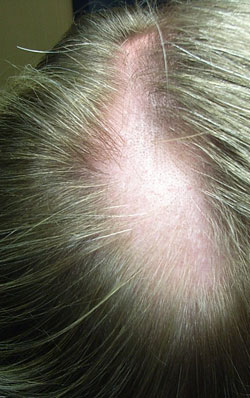 alopecia- Hair-loss 
